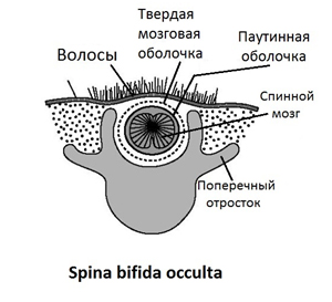 •	Spina bifida occulta
